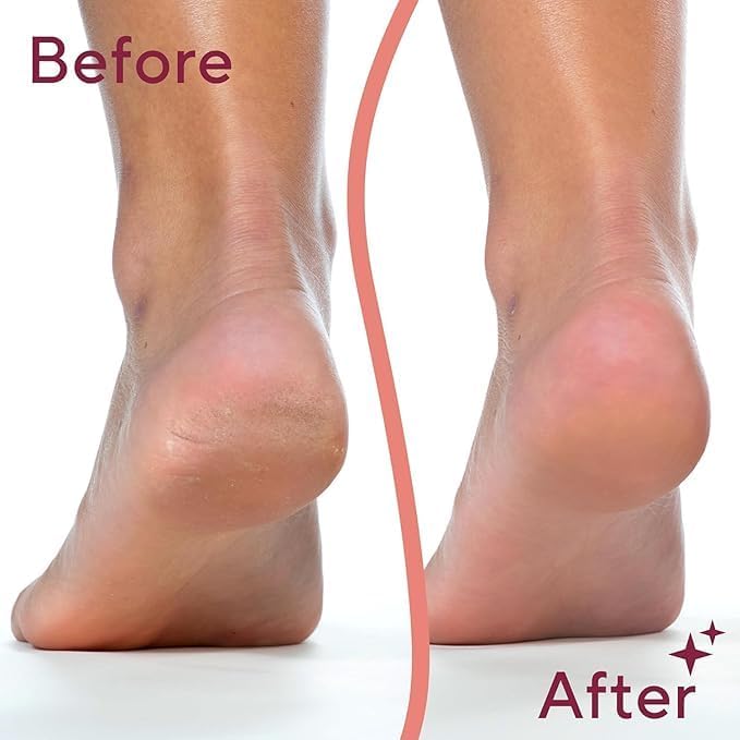 Tidy Jet™ Electric Callus Remover