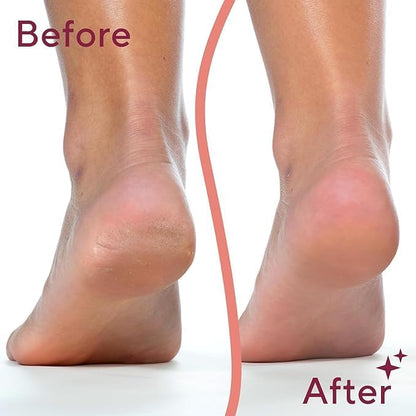 Tidy Jet™ Electric Callus Remover